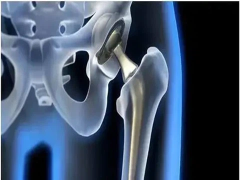 Wie koexistieren Titanlegierungen harmonisch mit menschlichem Gewebe?